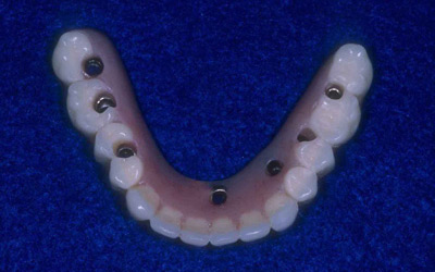 Full fixed lower denture prosthesis (note holes for screw insertion into implants)