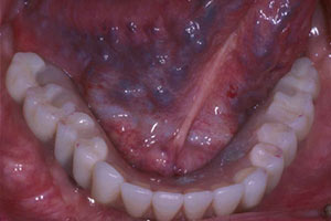 Fixed lower denture in position with access holes filled