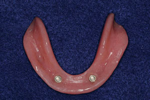 Lower overdenture with “inserts” to connect to locator abutments