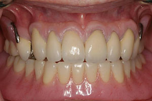 After insertion lower overdenture