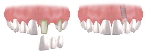 Dental Implants don’t affect the quality of adjacent teeth which would otherwise need to be filed down to support bridgework