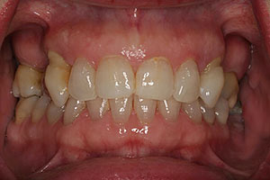Hopeless upper teeth with periodontal disease