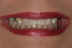 Before dentures
