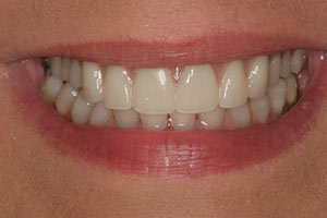 After dentures