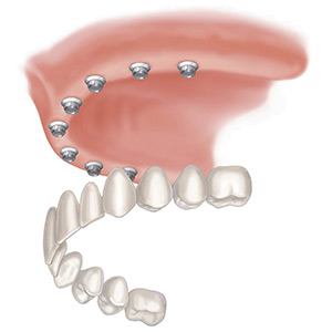 Replacing all your teeth can also be achieved by a “fixed” solution where the crowns are screwed into the implants and can only be removed by your dentist
