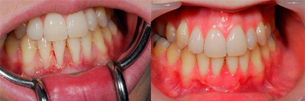 Another image showing before and after successful gum grafting
