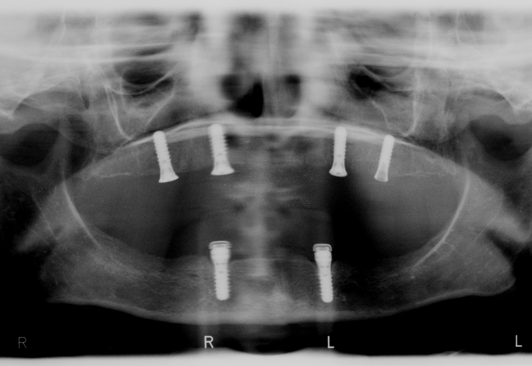 Implant supported dentures xray